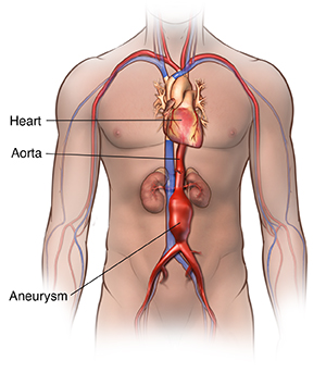 Front view of male outline showing abdominal aortic aneurysm.